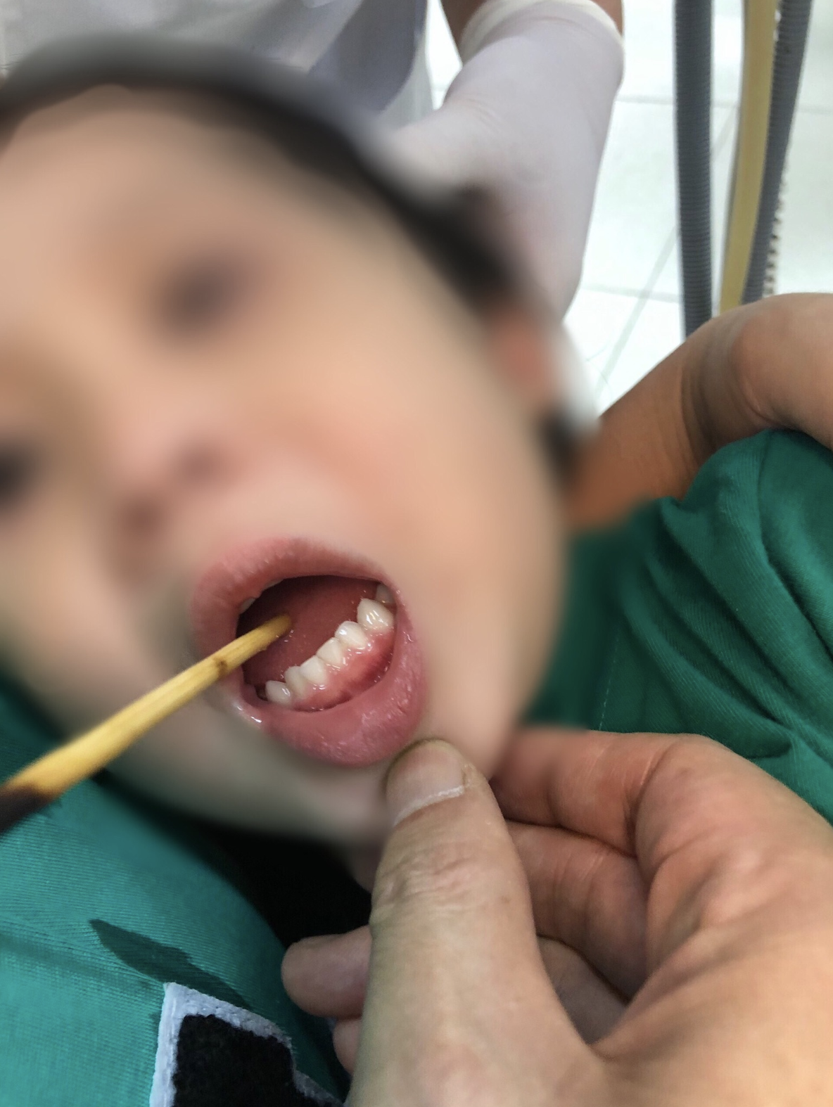 Cháu bé 3 tuổi bị que xiên thịt sắc nhọn đâm xuyên lưỡi